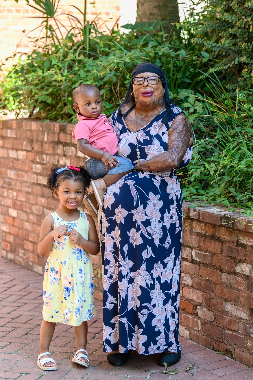 Black mother with burn scars and disabilities poses with her two children, a baby and a toddler.